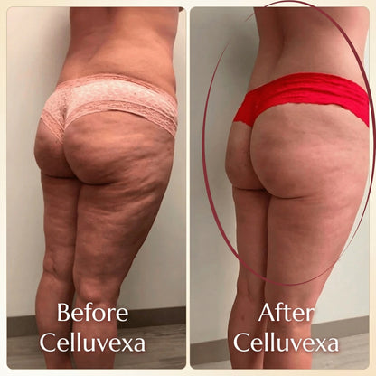 Celluvexa SculptPro™